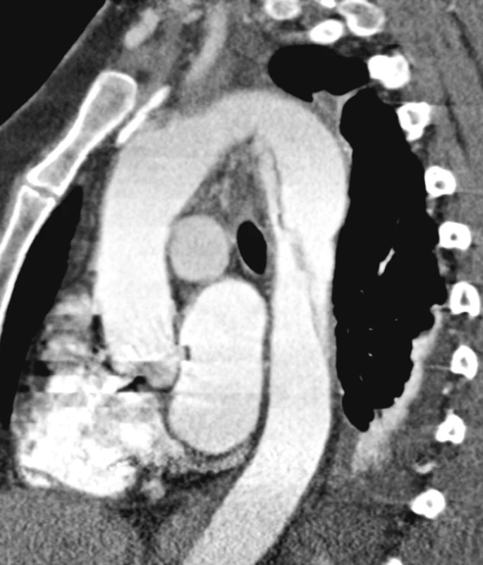 CTA obraz disekce typu B bez komplikací
Pic. 5. A CTA view of the type B dissection with no complications