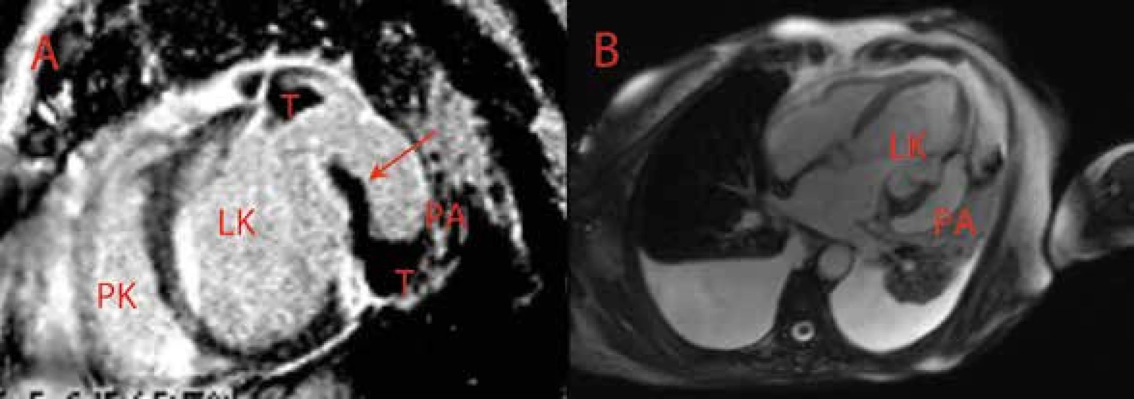 Parciálně trombotizované pseudoaneuryzma posterolaterální stěny levé komory – magnetická rezonance srdce