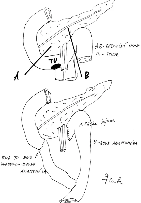 Resekce III. a IV. části dvanáctníku provedena retromezentericky a Y-Roux spojení mezi druhou částí duodena a kličky ilea
Fig. 6: Retromesenteric resection of duodenal parts III and IV and antecolic Y-Roux anastomosis between the duodenum (part II) and the jejunum