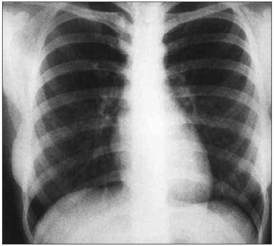 RTG hrudníku při nekomplikované stenóze aorty je normální.