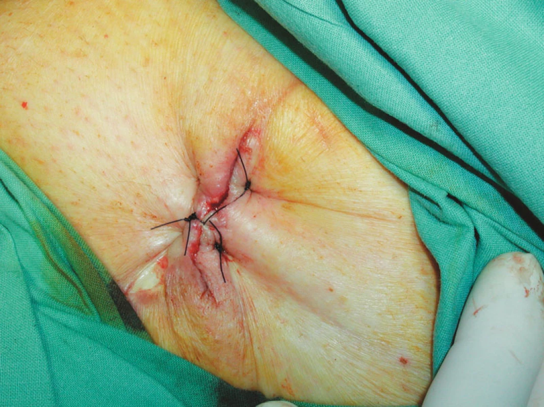 Sutura rány po odstranění V.A.C.
Fig. 9. A wound suture after the V.A.C. system removal