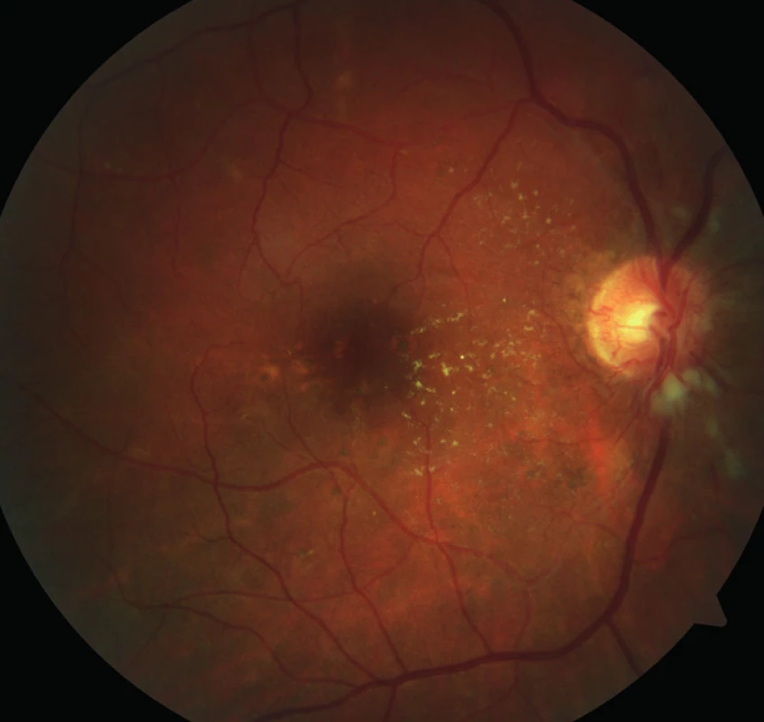 Pravé oko. Výrazná hypertonická retinopatie, stadium 3 dle Keitha. Dominuje zvýraznění kapilární sítě na papile.