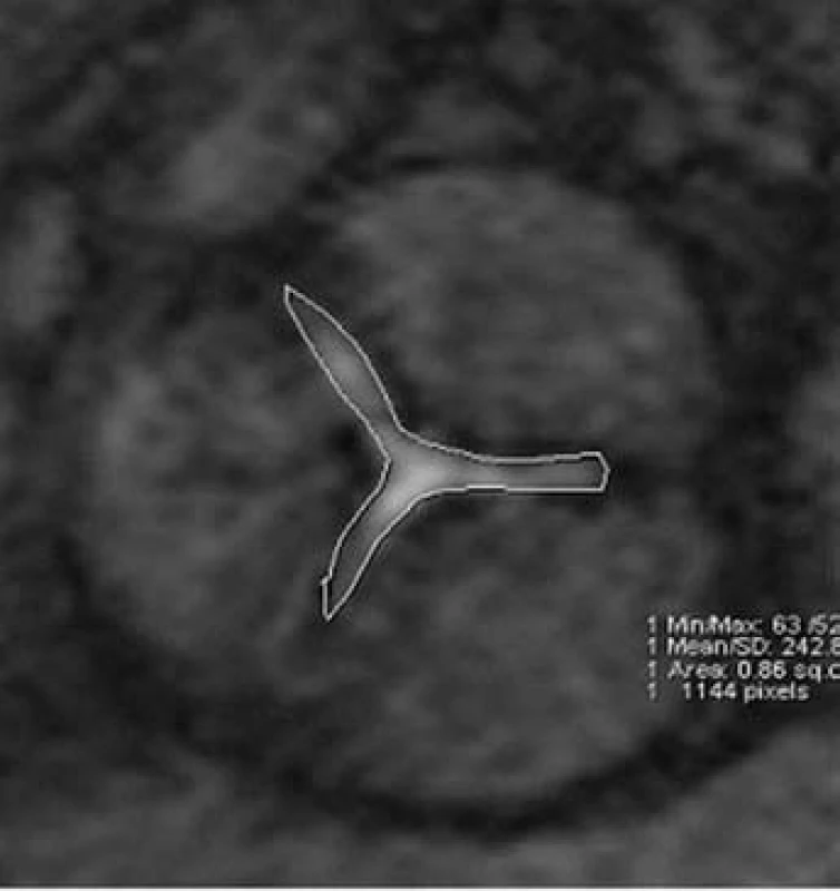 Aortální stenóza. Planimetrie aortálního ústí u nemocného s významnou aortální stenózou.