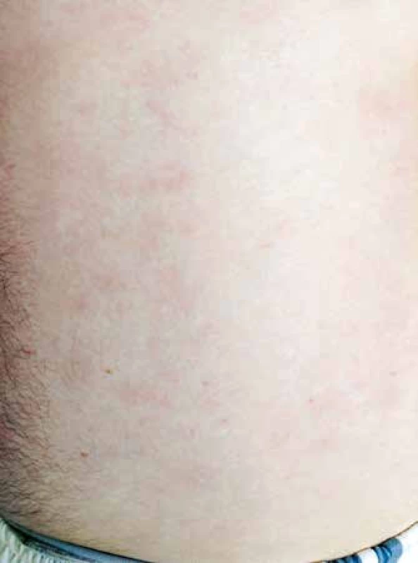 Kožní léze na trupu, stav po zahájení předfáze kortikosteroidy