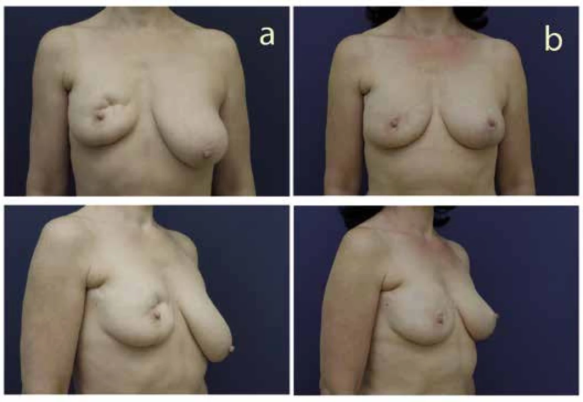Rekonstrukce prsu přenosem vlastní tukové tkáně u pacientky po segmentektomii
(a – před operací, b – po operaci)