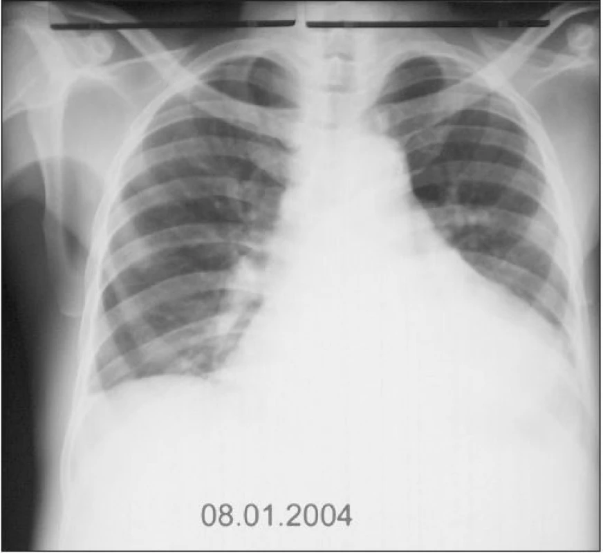 RTG srdce a plic (8. 1. 2004): Patrná regrese velikosti srdečního stínu přetrvává dilatace doleva, téměř ke stěně hrudní, regrese fluidotoraxu, ostatní nález stacionární.
