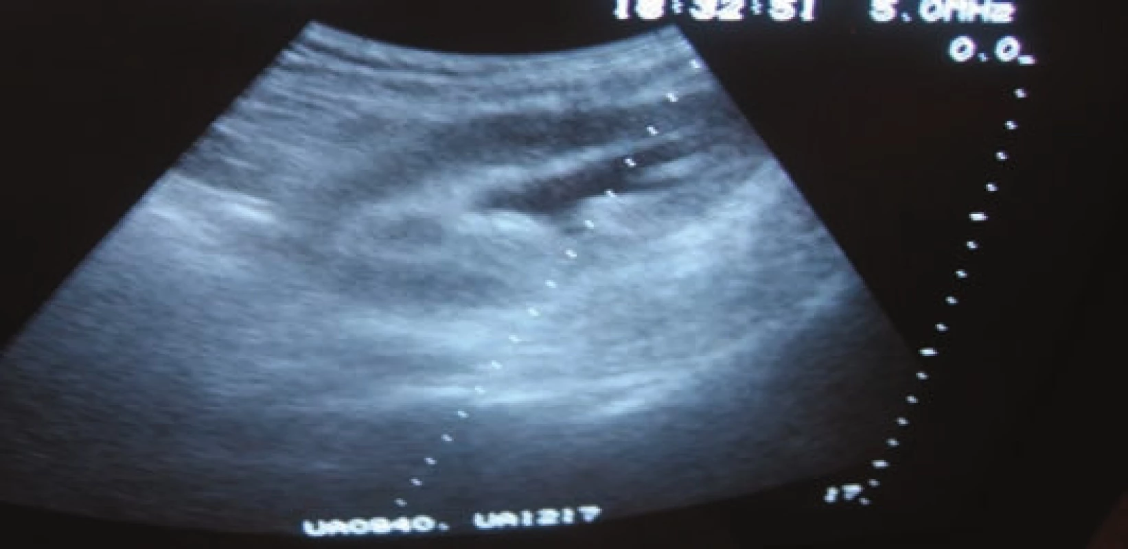 Sonografie dilatovaného dutého systému ledviny.