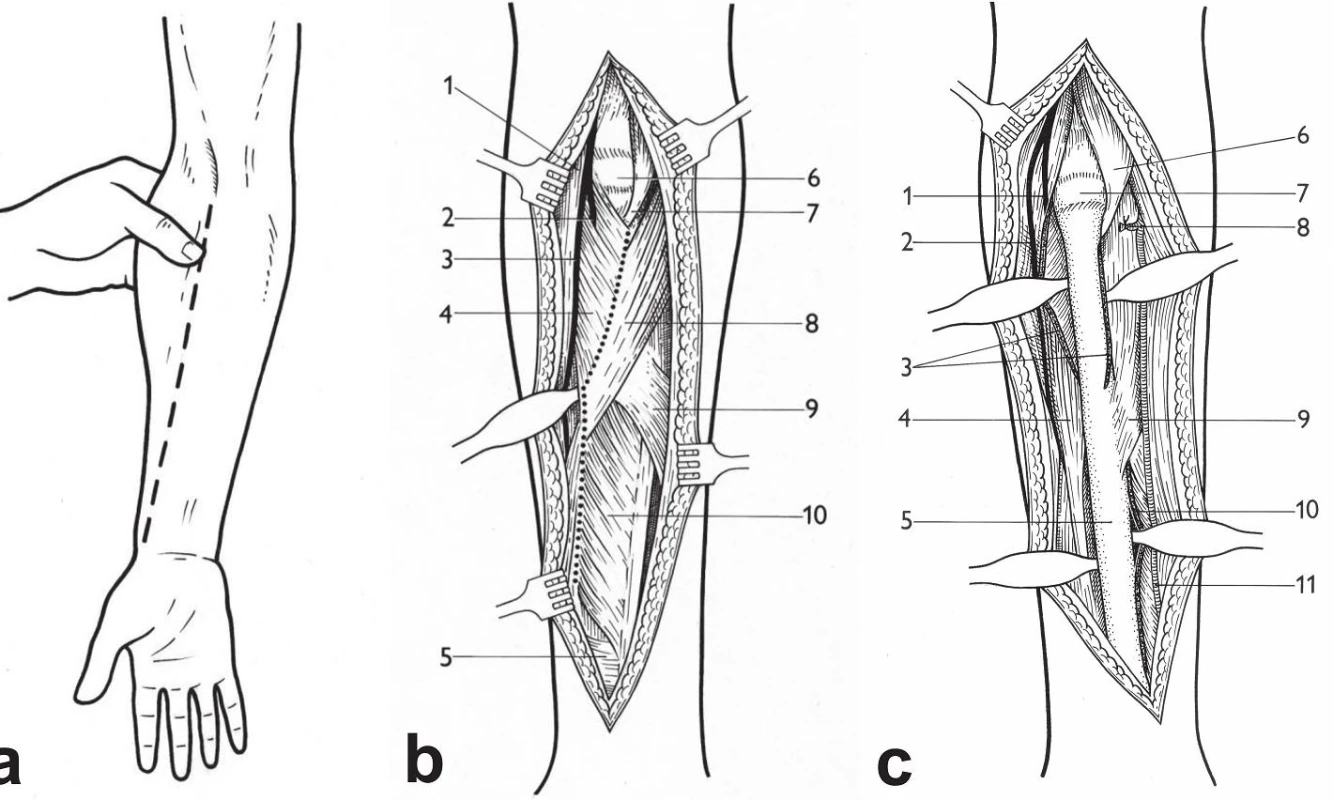 Henryho přístup – schéma: a – identifikace „mobile wad“; b – linie preparace: 1 – m. brachioradialis, 2 – r. profundus n. radialis, 3 – r. superficialis n. radialis, 4 – m. supinator, 5 – m. pronator quadratus, 6 – kloubní pouzdro kryjící hlavici radia, 7 – šlacha m. biceps brachii, 8 – m. pronator teres, 9 – m. flexor digitorum superficialis (caput radiale), 10 – m. flexor pollicis longus; 
c – stav po uvolnění svalů: 1 – r. profundus n. radialis, 2 – r. superficialis n. radialis, 3 – m. supinator, 4 – m. brachioradialis, 5 – diafýza radia, 6 – šlacha m. biceps brachii, 7 – kloubní pouzdro kryjící hlavici radia, 8 – podvázaná a. radialis recurrens, 9 – m. pronator teres, 10 – m. flexor pollicis longus, 11 – a. radialis. &lt;i&gt;(Reprinted from Bartoníček J. Operační přístupy u zlomenin hlavičky a diafýzy rádia [Surgical approaches in fractures of the head and shaft of radius]. Acta Chir. Orthop Traumatol Čech 1988;55:497−516.)&lt;/i&gt;
Fig. 8: Henry approach – drawings: a – identification of the mobile wad; b – dissection line:
 1 – brachioradialis, 2 – deep branch of radial nerve, 3 – superficial branch of radial nerve, 
4 – supinator, 5 – pronator quadratus, 6 – joint capsule covering radial head, 7 – biceps brachii tendon, 8 – pronator teres, 9 –flexor digitorum superficialis (radial head), 10 – flexor pollicis longus; c – situation after muscle detachment: 1 – deep branch of radial nerve, 2 – superficial branch of radial nerve, 3 – supinator, 4 – rachioradialis, 5 – radial shaft, 6 – biceps brachii tendon, 7 – joint capsule covering radial head, 8 – ligated radial recurrent artery, 9 – pronator teres, 10 – flexor pollicis longus, 11 – radial artery. &lt;i&gt;(Reprinted from Bartoníček J. [Surgical approaches in fractures of the head and shaft of radius]. Acta Chir Orthop Traumatol Čech 1988;55:497−516.)&lt;/i&gt;