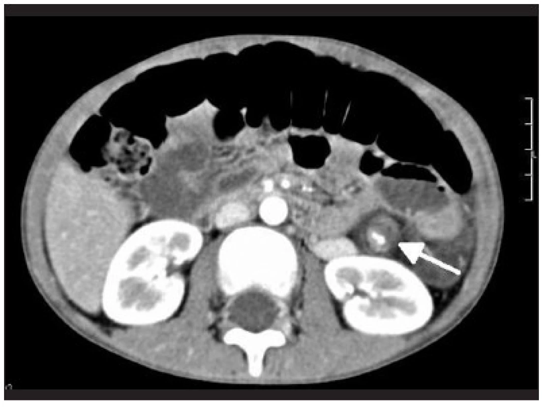 CT angiografia torzie lienálnej artérie
Fig. 4. CT angiography of splenic artery torsion