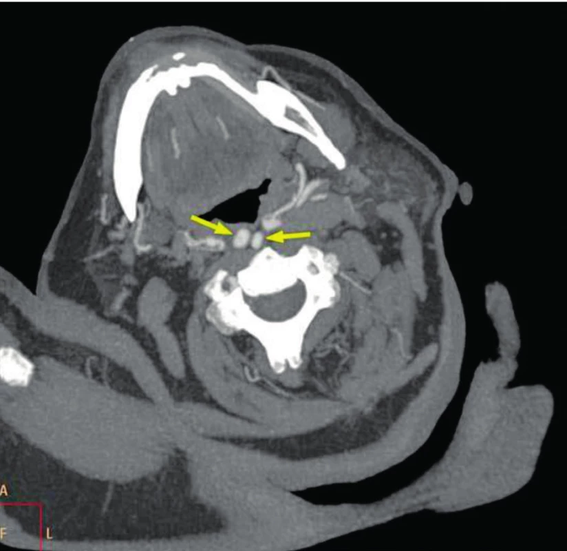 CT postkontrastní snímek arteriální fáze - šipka ukazuje na retrofaryngeální průběh a. carotis interna.