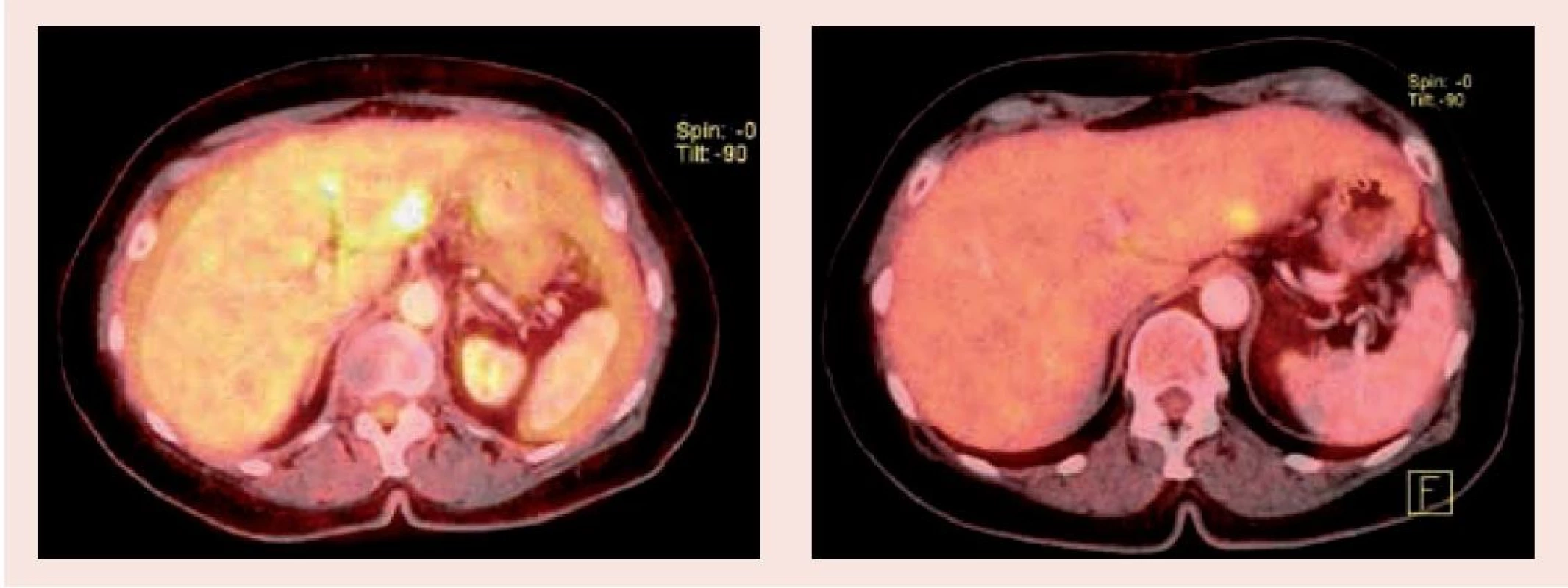 PET/CT vyšetření před zahájením léčby (1.1) a po 3 měsících (1.2) – oblast jater
