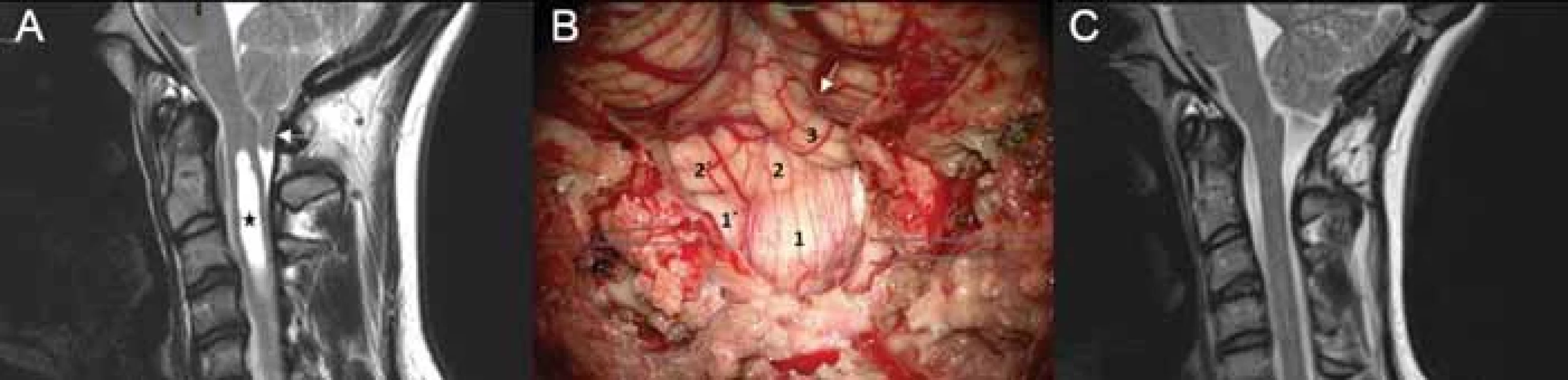 Operace Chiariho malformace typu I se syringomyelií.