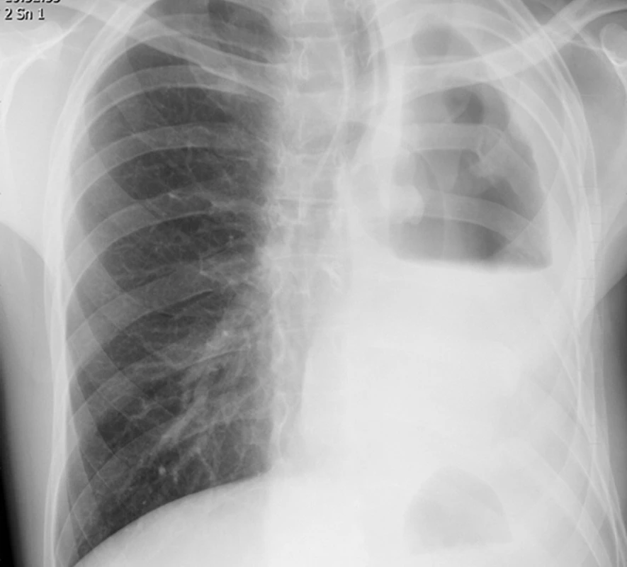 RTG plic s nálezem výpotku v levé pleurální dutině