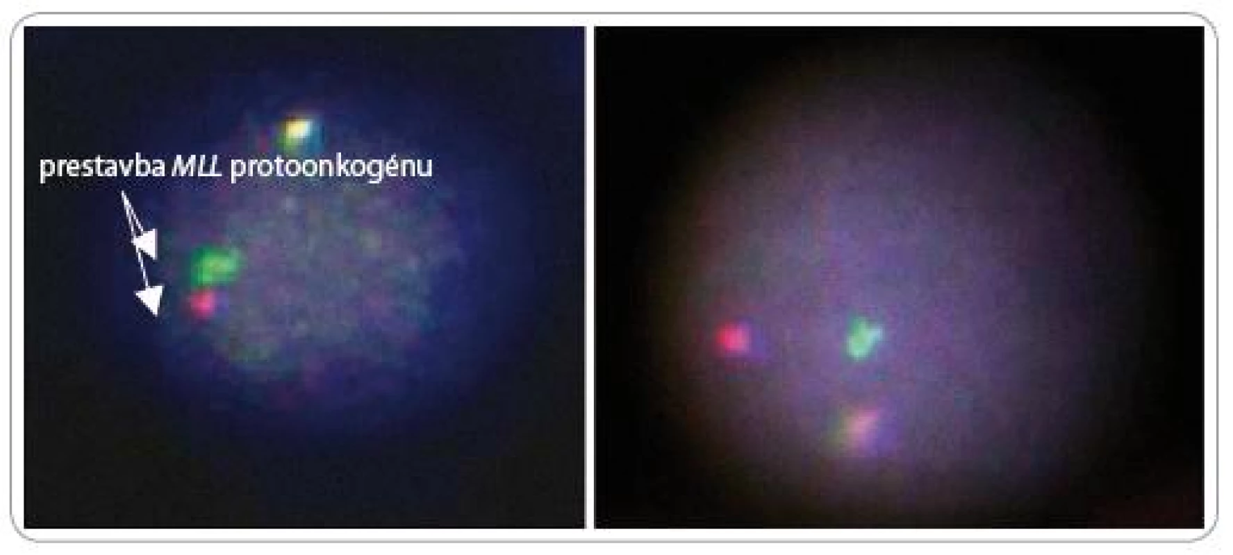 Výsledok fluorescenčnej analýzy interfázneho jadra, získaný zosnímaním CCD kamerou vo fluorescenčnom mikroskope.