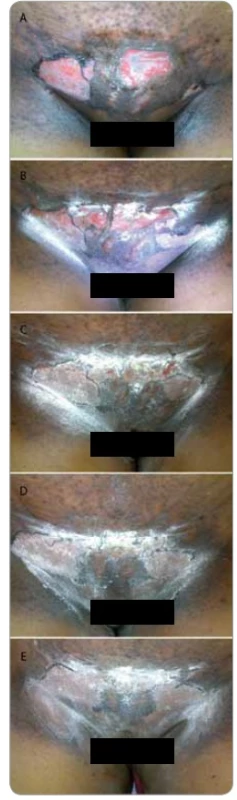 Shows a female patient who completed radiotherapy 50 Gy in 25 fractions 5 fractions per week, for Cancer Cervix. She presented with grade III moist desquamation of the skin with deep dermal exposure. The patient was referred to us for cytokine therapy. 2A: before cytokine injection, 2B: day 2, 2C: day 3, 2D: day 4, 2E: day 5. Shows complete healing.