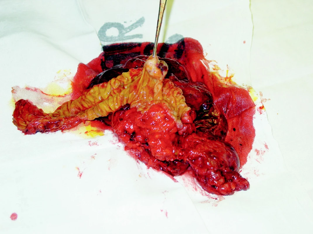Resekát nádoru s duodenem a hlavou pankreatu
Fig. 3. The tumor resecate, including the duodenum and the pancreatic head