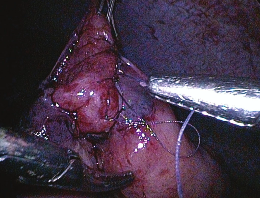 The jejune loop was fixed to the anterior abdominal wall and was closed by laparoscopy with a ongoing suture.