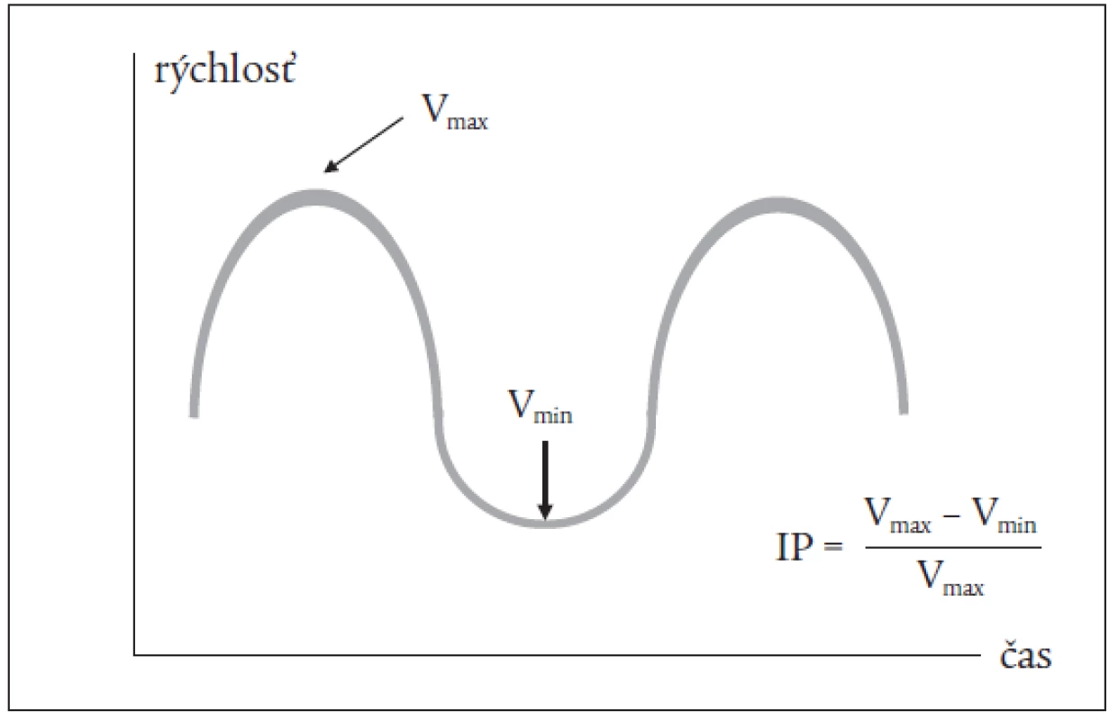 Schéma doplerovského signálu z portálnej vény a výpočtu indexu pulzatility (IP).