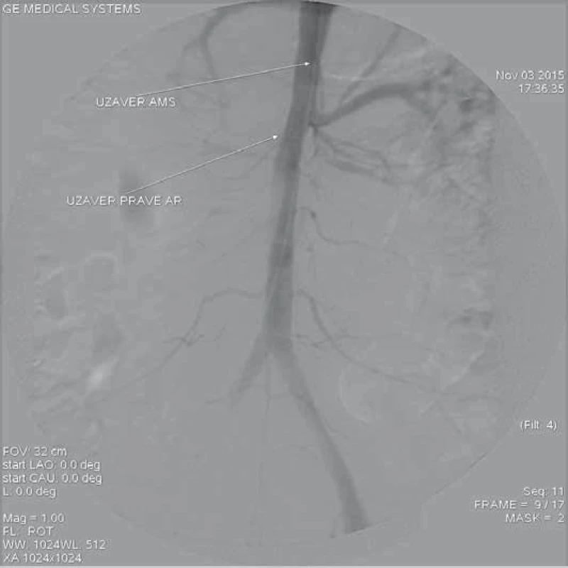 Kontrolní angiografie břišní aorty po zavedení stentgraftu. Dobře se plní a. celiaca, levá renální tepna a proximální část ilického řečiště vlevo. Neplní se horní mezenterická tepna a pravá ledvinná tepna. Uzávěr pravého ilického řečiště je dán zavedeným instrumentáriem.