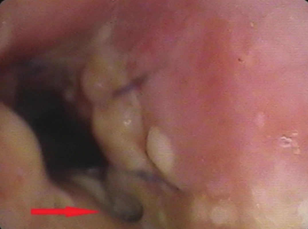 Bronchoskopický pohled: drobná píštěl v anastomóze (trachea - hlavní levý bronchus)
Fig. 5: Bronchoscopic view: small anastomotic fistula (trachea – left main bronchus)