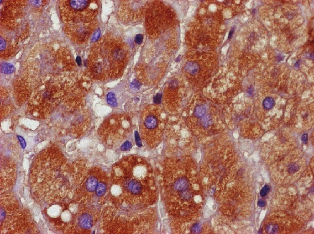 Imunochemická reakce na přítomnost alfa-1-antitrypsinu v cytoplazmě hepatocytů – pozitivní hnědé zbarvení.