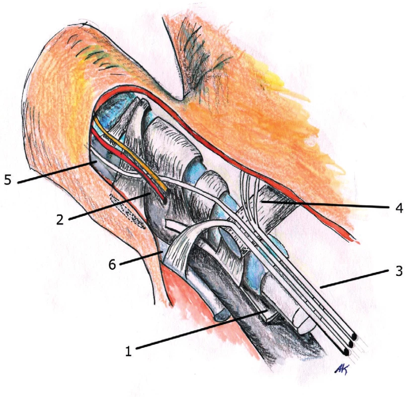 Anatomy of pretendinous fibers in the area of its transition to the fingers
1. Flexor tendons
2. Neurovascular bundle
3. Pretendinous fibres
4. Superficial fibers
5. Intermediary fibers
6. Deep fibers (an its course to dorsal extensor aponeurosis)