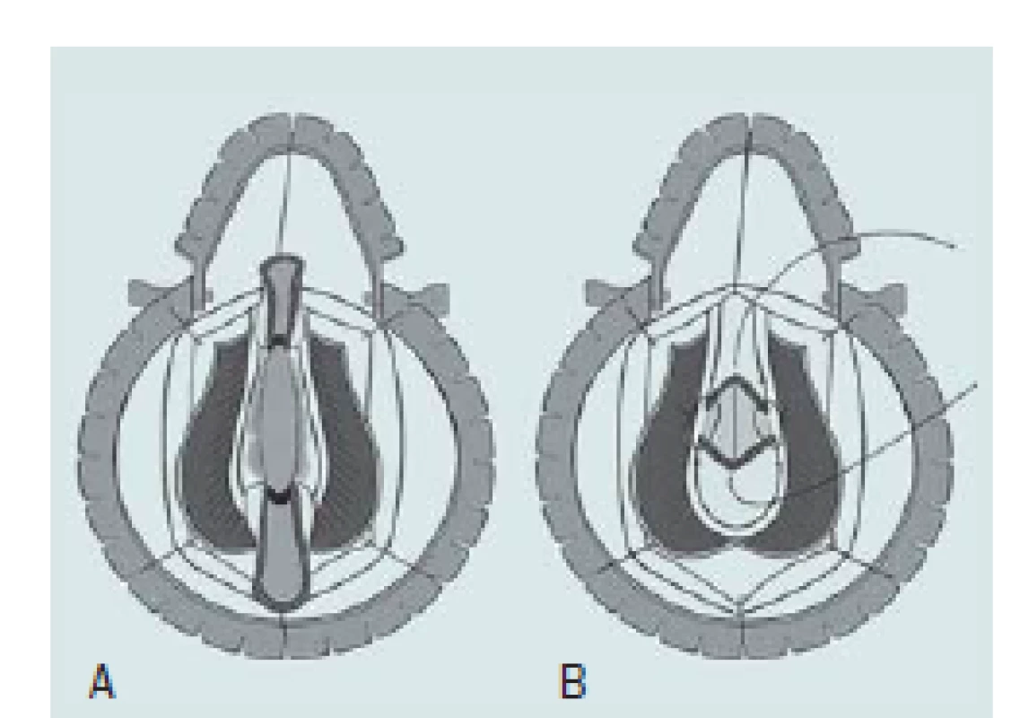 Anastomóza s augmentací.
A – Úplné přerušení močové trubice, podélné otevření uretrálních konců podél dorzálního povrchu a sutura graftu přes corpora.
B – Distální konec močové trubice je stažen směrem dolů a proximální uretra je současně vytlačena tak, aby překrývala graft, a močová trubice je uzavřena na ventrálním povrchu technikou konec ke konci.