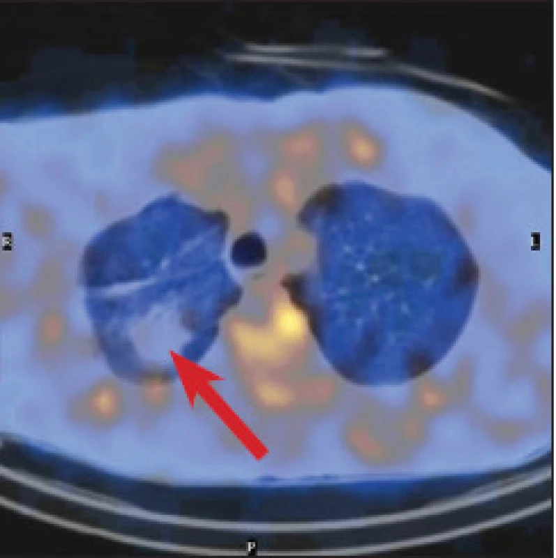 Galliová scintigrafie v červnu 2011. Celotělový scan a SPECT hrudníku a břicha po 96 hodinách. Opět je patrná fyziologická distribuce, navíc také v colon. Hyperdenzní ložisko v pravé plíci gallium neakumuluje (dolní řada: vlevo CT, uprostřed SPECT, vpravo fúze).