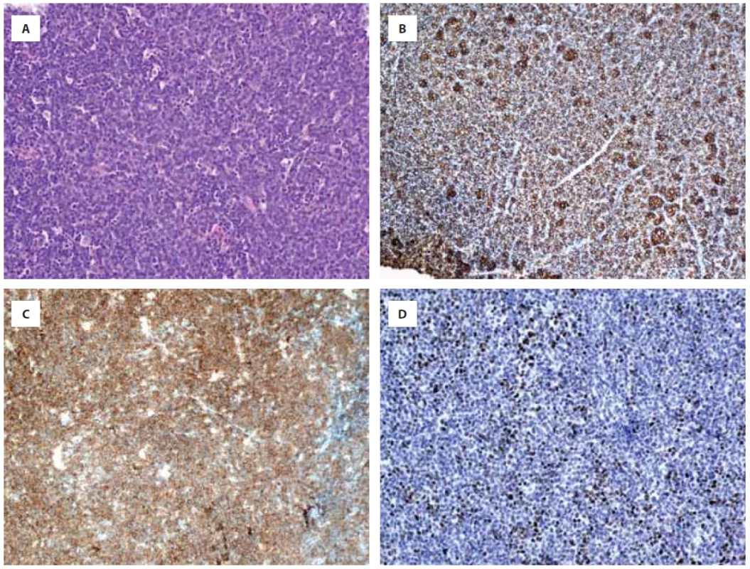 Série vybraných imunohistochemických vyšetření tkáně tumoru z doby relapsu, barveno hematoxylin-eosinem (A), CD 20 (B), CD19 (C) a c-myc (D).