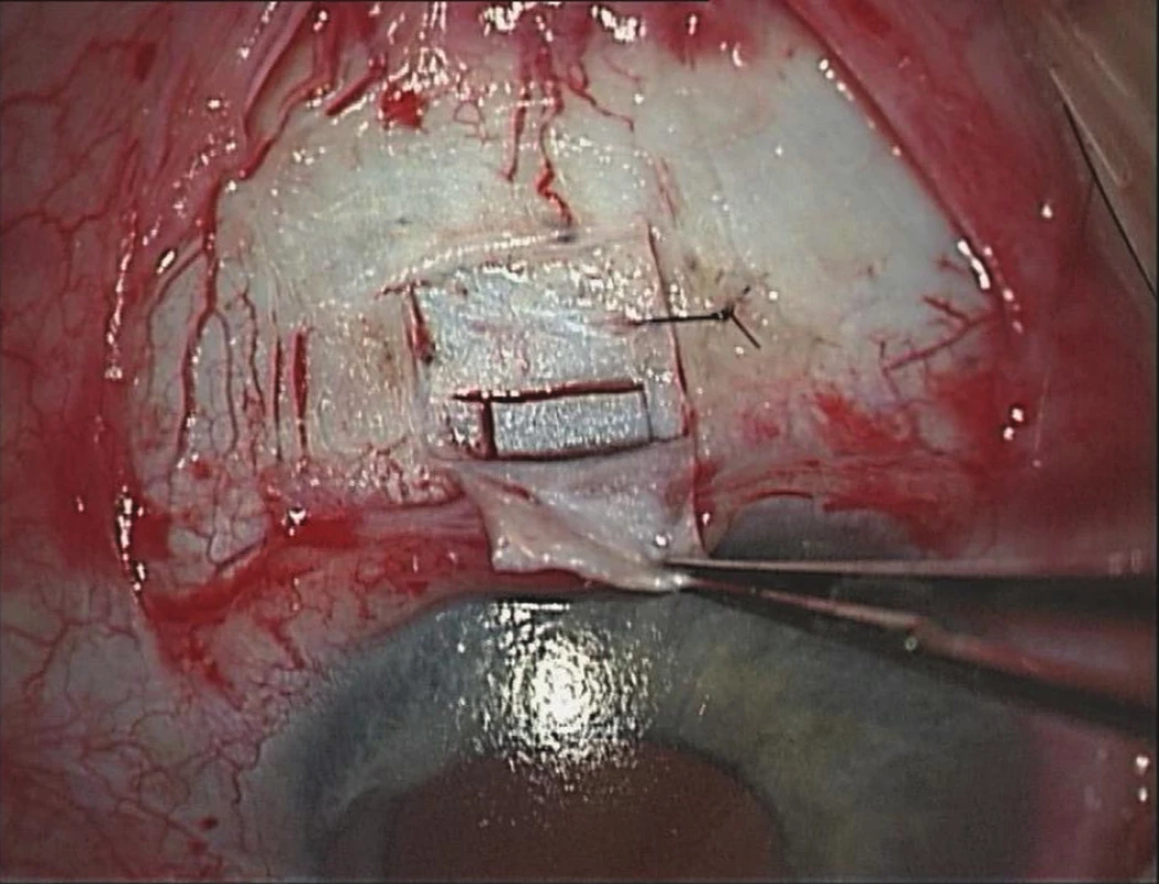 Pravé oko v průběhu 2. operace – trabekulektomie s mitomycinem C a bazální iridektomie