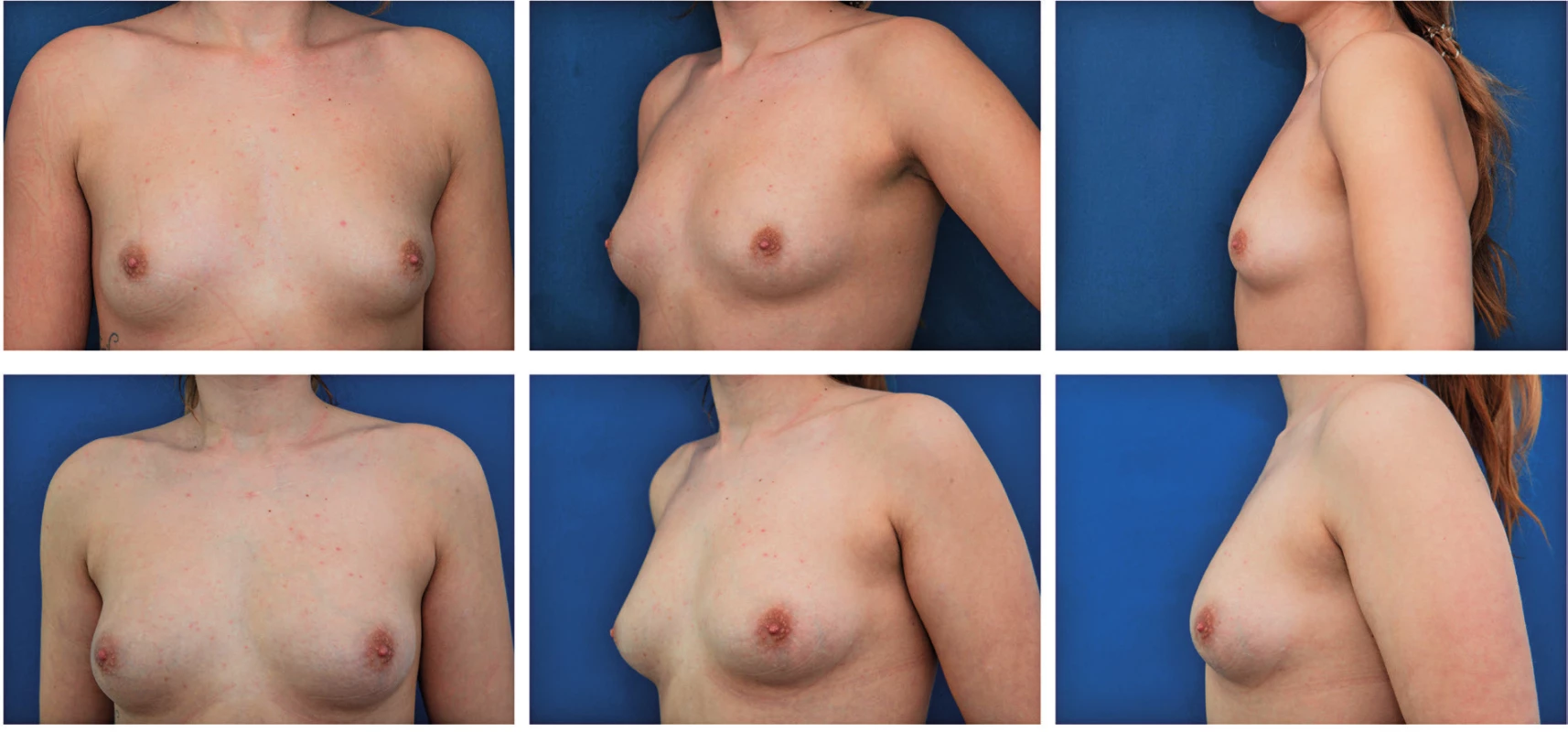 Patient before and 6 months after one session of autologous fat breast augmentation