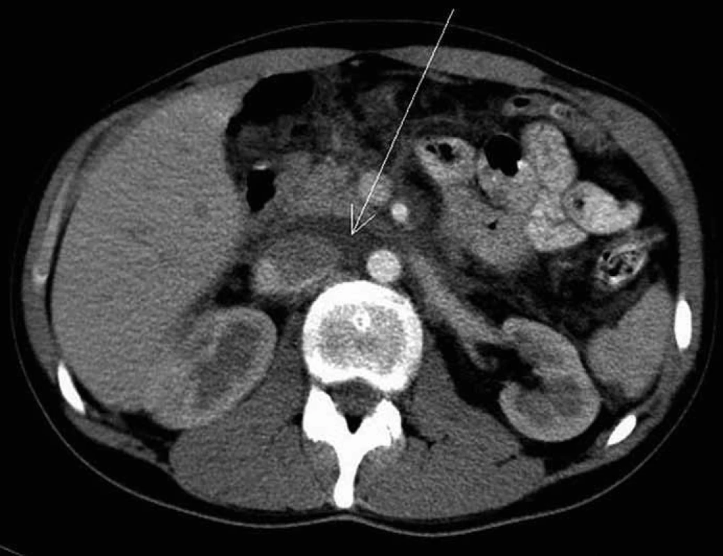 CT vyšetření břicha po intravenózní aplikaci jodové kontrastní látky ze dne 9. 5. 2005 – před zahájením léčby. Šipka ukazuje na patologickou infiltraci v retroperitoneu, která je hypodenzní a postkontrastně se nesytí.