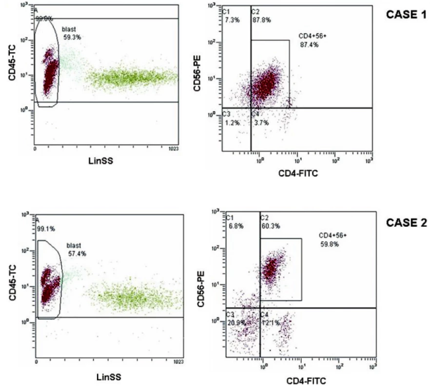 Flowcytometrická analýza nádorové populace CD4+56+
Na horních dvou grafech je zobrazena formou dot-plots flowcytometrická analýza pro kazuistiku 1, na dolních dvou grafech pro kazuistiku 2.
Na levých grafech je v gate A zabrána populace všech leukocytů nesoucí znak CD45+ a v gate blast populace lymfocytů, v níž je patrná patologická CD45dim+ populace nádorových buněk.
Analýza fluorescence FITC vs. PE z gate A je znázorněna na grafech vpravo, kde je patrná společná populace fenotypu CD4+CD56+.
