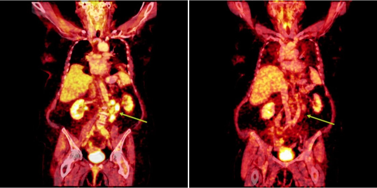 Srovnání snímků integrované pozitronové emisní tomografie (s použitím 18F-fluoro-deoxy-glukózy) a počítačové tomografie při relapsu (a) a po skončení léčby 90Y-ibritumomab tiuxetanem (b) u prvního pacienta s folikulárním lymfomem.