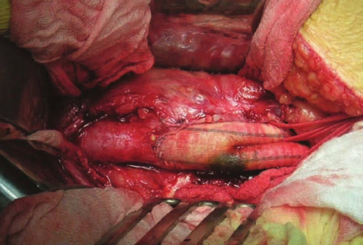 Infikovaná bifurkační cévní protéza (peroperační foto).