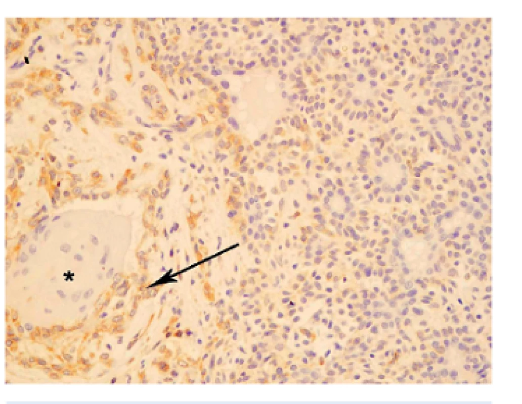 Primárny pleomorfný adenóm – ložisko dlaždicovobunkovej metaplázie. bcl-2 negatívna imunoreakcia štruktúr napodobňujúcich interkalárne dukty na pravej strane obrázku. Oblasti skvamocelulárnej metaplázie (hviezdička) obklopené bcl-2 pozitívnymi intermediárnymi bunkami (šípka) (x 200).