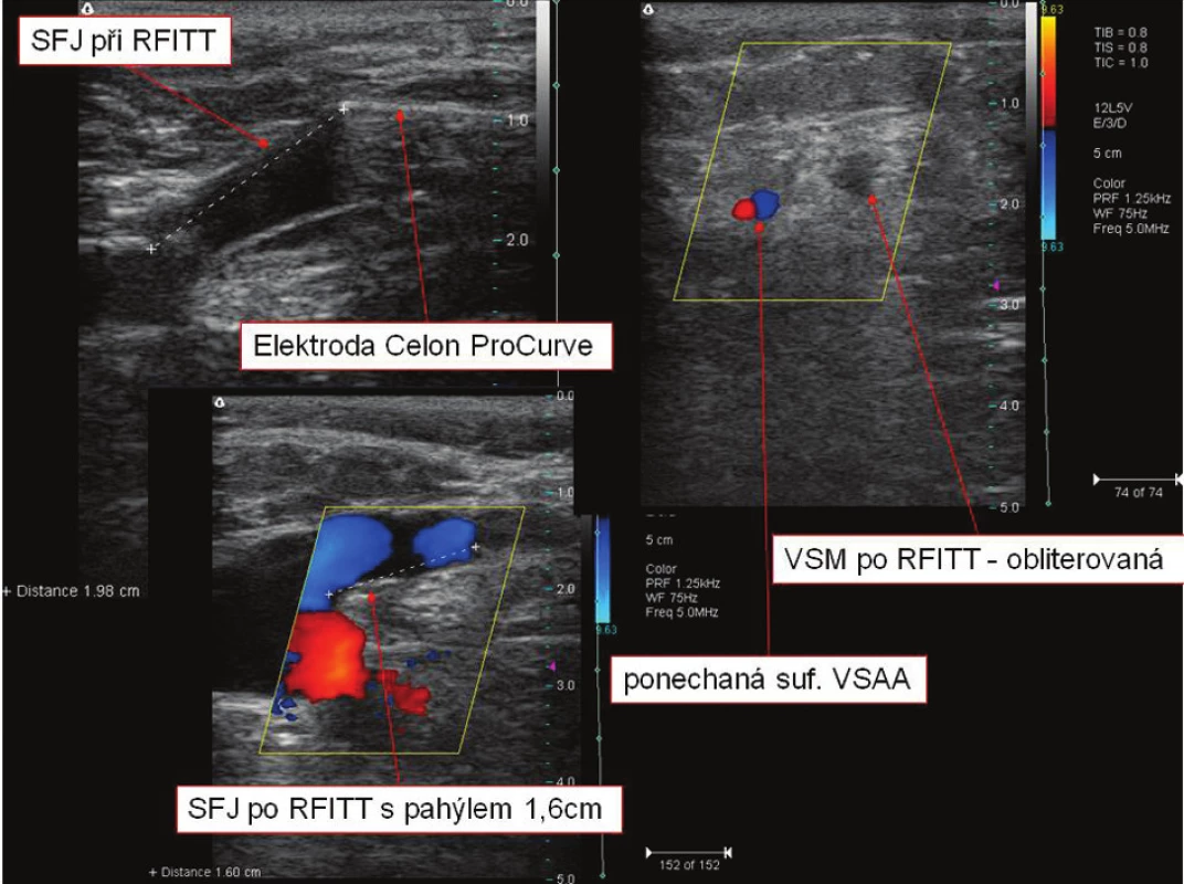SFJ při a po endovaskulární operaci RFITT, VSM po RFITT (RFITT = Radiofrequent Induced Thermo-Terapy)
Fig. 5. SFJ during and after endovascular RFITT surgery, VSM after RFITT (RFITT = Radiofrequent Induced Thermo- Terapy),