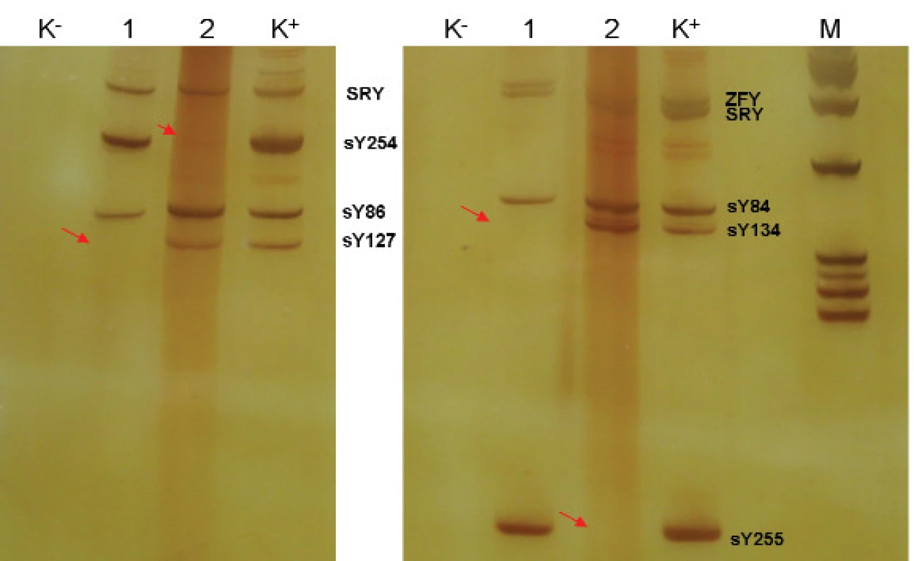 Výsledek vyšetření mikrodelece AZF a,b,c.
1 - pacient - delece AZF b
2 - pacient - delece AZF c
K+ pozitivní kontrola
K- negativní kontrola
M - marker molekulových hmotností
detekce oblasti AZFa: sY84, sY86,
detekce oblasti AZFb: sY127, sY134
detekce oblasti AZFc: sY254, sY255