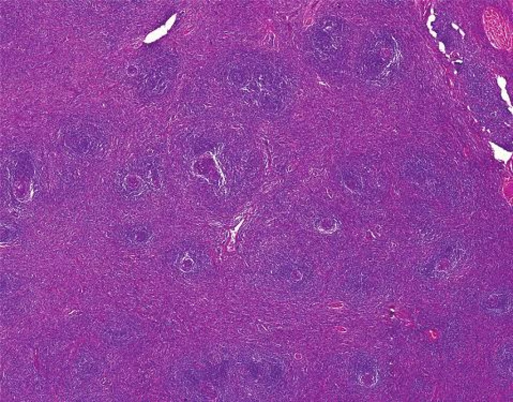 Histologický obraz hyalinně vaskulárního typu Castlemanovy choroby
Fig. 3: Histological picture of hyalin-vascular type of Castleman´s disease