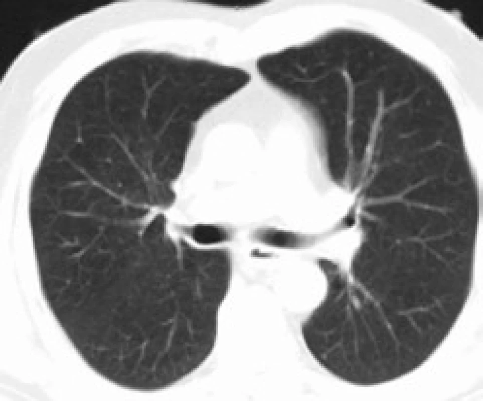 Normální CT nález plicního parenchymu.
