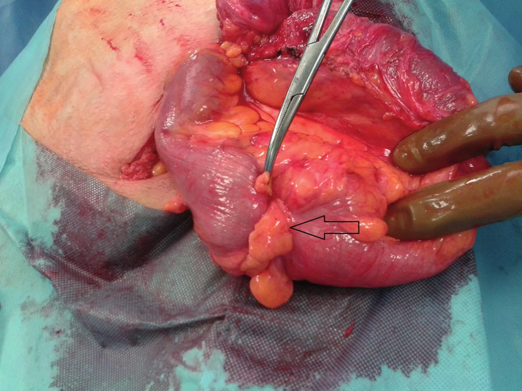 Tumor sigmy v ľavostrannej slabinovej prietrži
Fig. 1: The sigmoid tumour is herniated into the left inguinal hernia