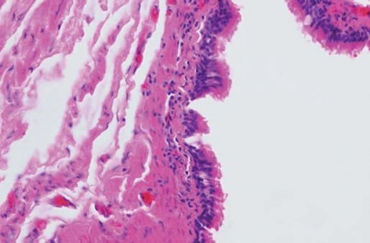 Histologický nález, uvnitř cysty cylindrický řasinkový epitel respiračního typu.
Fig. 4. Histology findings, inside the cyst there is columnar ciliated epithelium of the respiratory type.