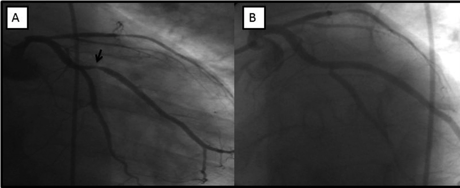V části A angiograficky patrná významná stenóza marginální tepny (šipka), v levé části obrázku stav po implantaci stentu s optimálním konečným výsledkem.