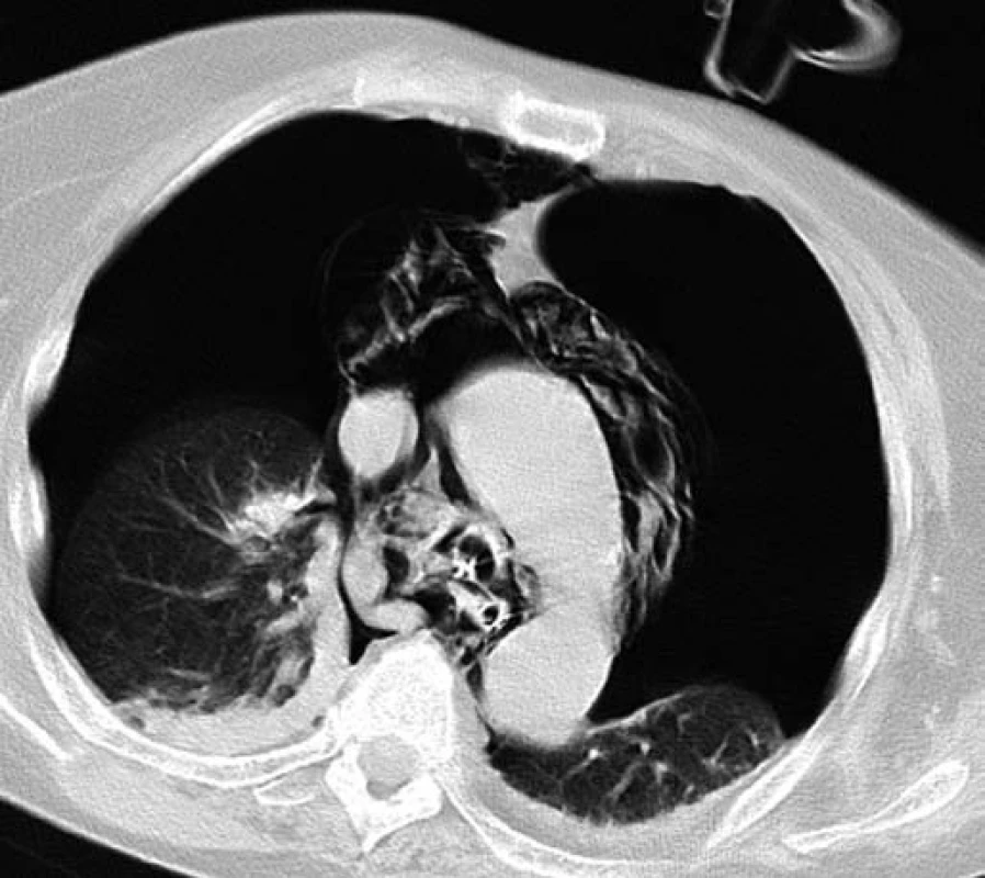 CT plic – bilaterální pneumothorax.
Fig. 2. CT of the lungs - bilateral pneumothorax.