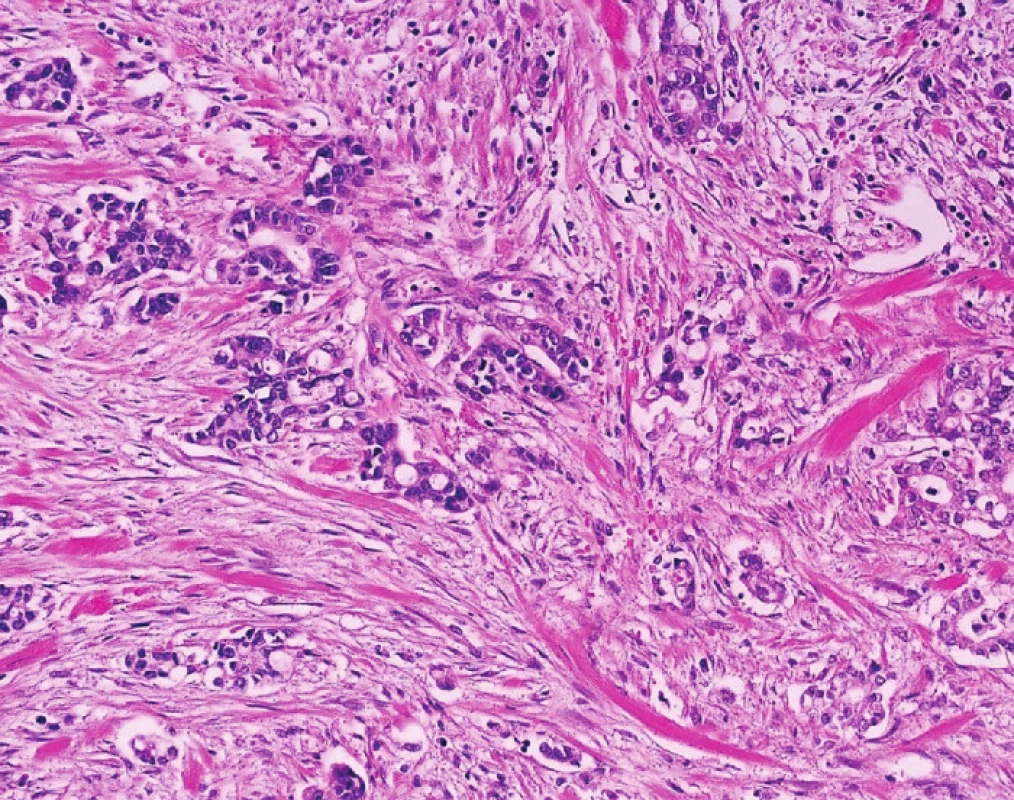 Typická morfologie cholangiocelulárního karcinomu 
Jde o tubulární adenokarcinom s nápadnou fibroprodukcí.
Fig. 4: Typical morphological features of cholangiocellular carcinoma are shown here 
Structures of tubular adenocarcinoma surrounded by dense fibrotic tissue.