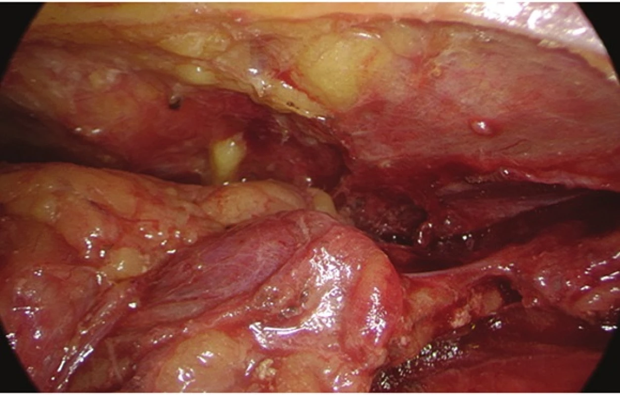 Videothorakoskopický pohled na adenom příštítného tělíska uloženého v thymu
Fig. 4: Videothoracoscopic view of parathyroid adenoma in the thymus