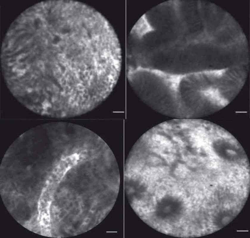 pCLE obrazy – zdravý choledochus (A, B), patologicky změněný choledochus (C, D).