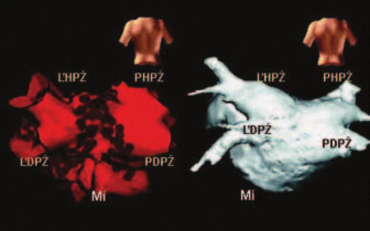 Vľavo trojrozmerný model ľavej predsiene s vústením štyroch pľúcnych žíl vytvorený NavX systémom v PA projekcii. 