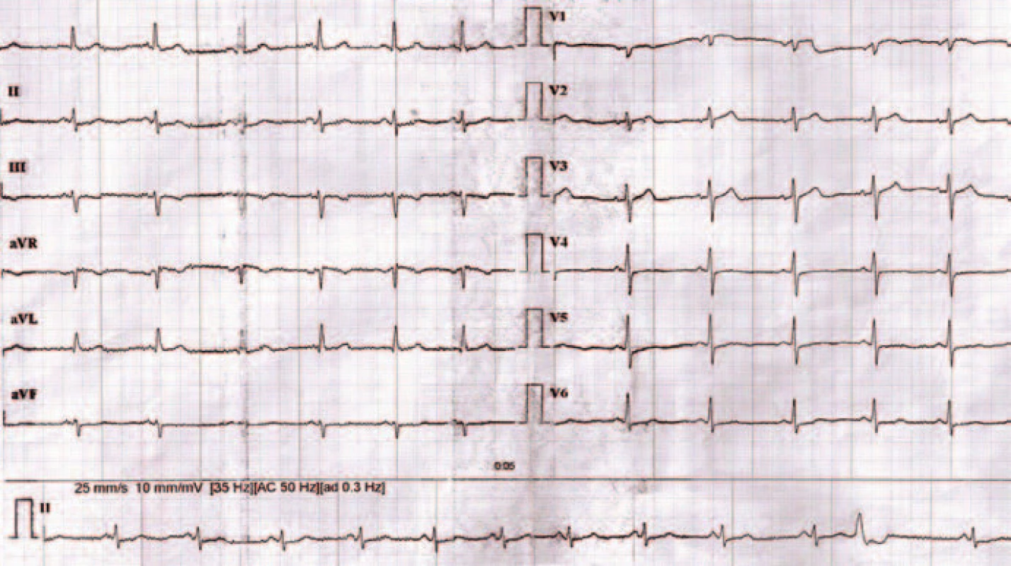 EKG záznam 3 mesiace po liečbe.