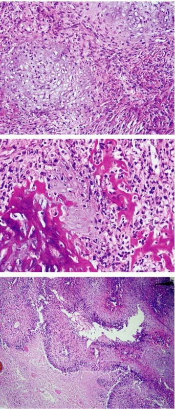 Chondroblastický osteosarkóm: lalôčiky malígnej chrupky s vretenobunkovou proliferáciou na periférii (a), tvorbou osteoidu (b) a ložiskovými nekrózami (c). HE, zväčšenie 100, 200 a 40-krát